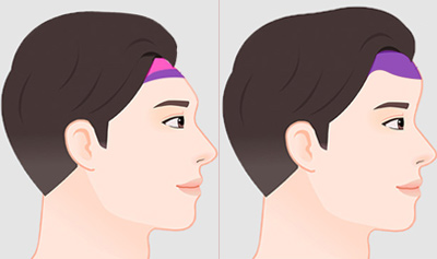 헤어라인 디자인이 곧 모발이식결과